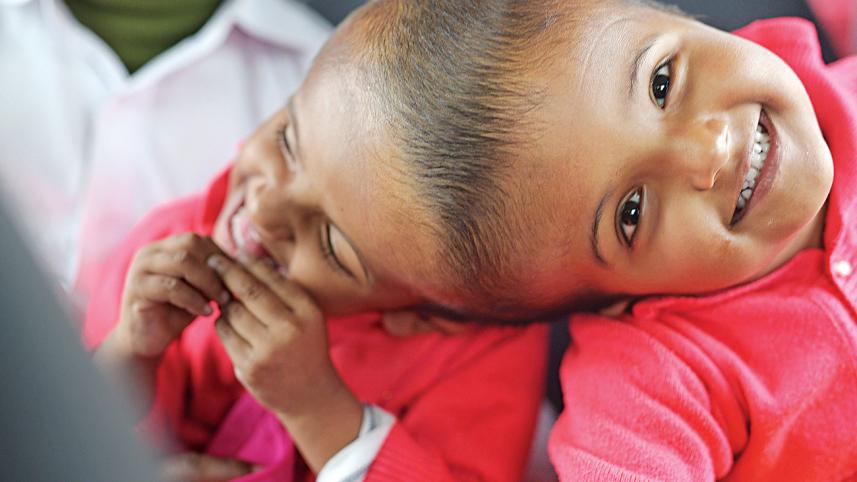 bangladeshi twins surgery