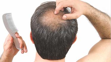 men hair loss