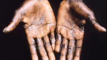 monkeypox virus